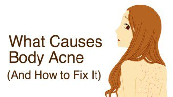body acne