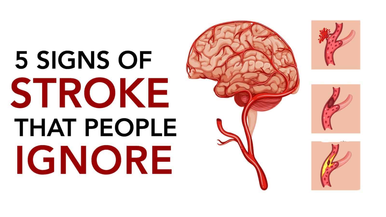 Avoid stroke