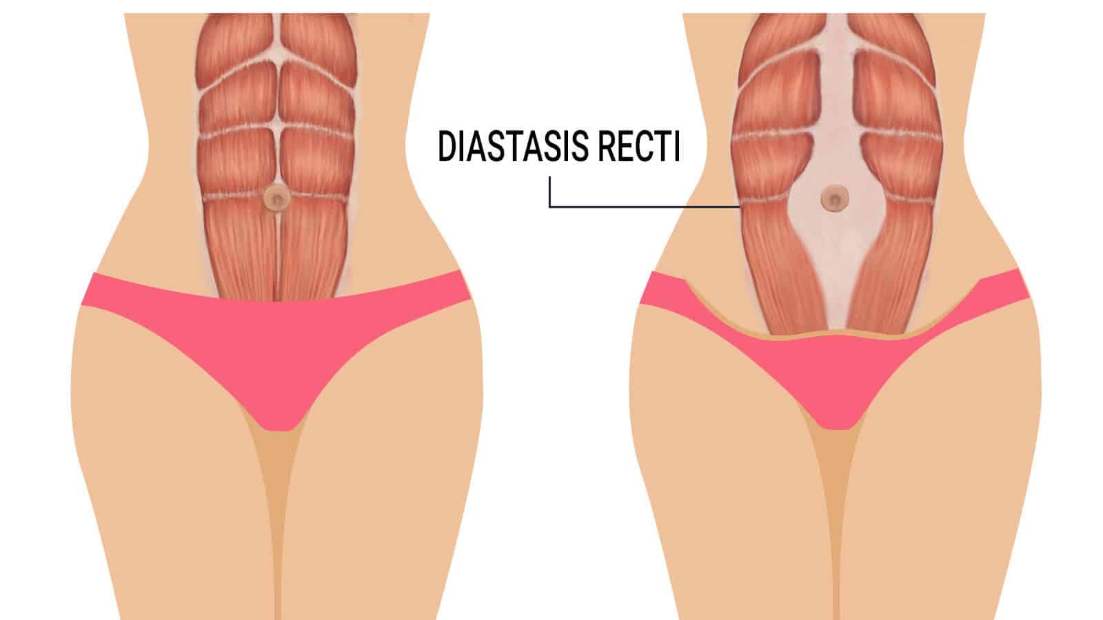 diastasis recti