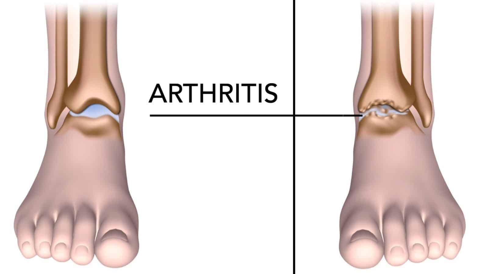 how reduce arthritis pain