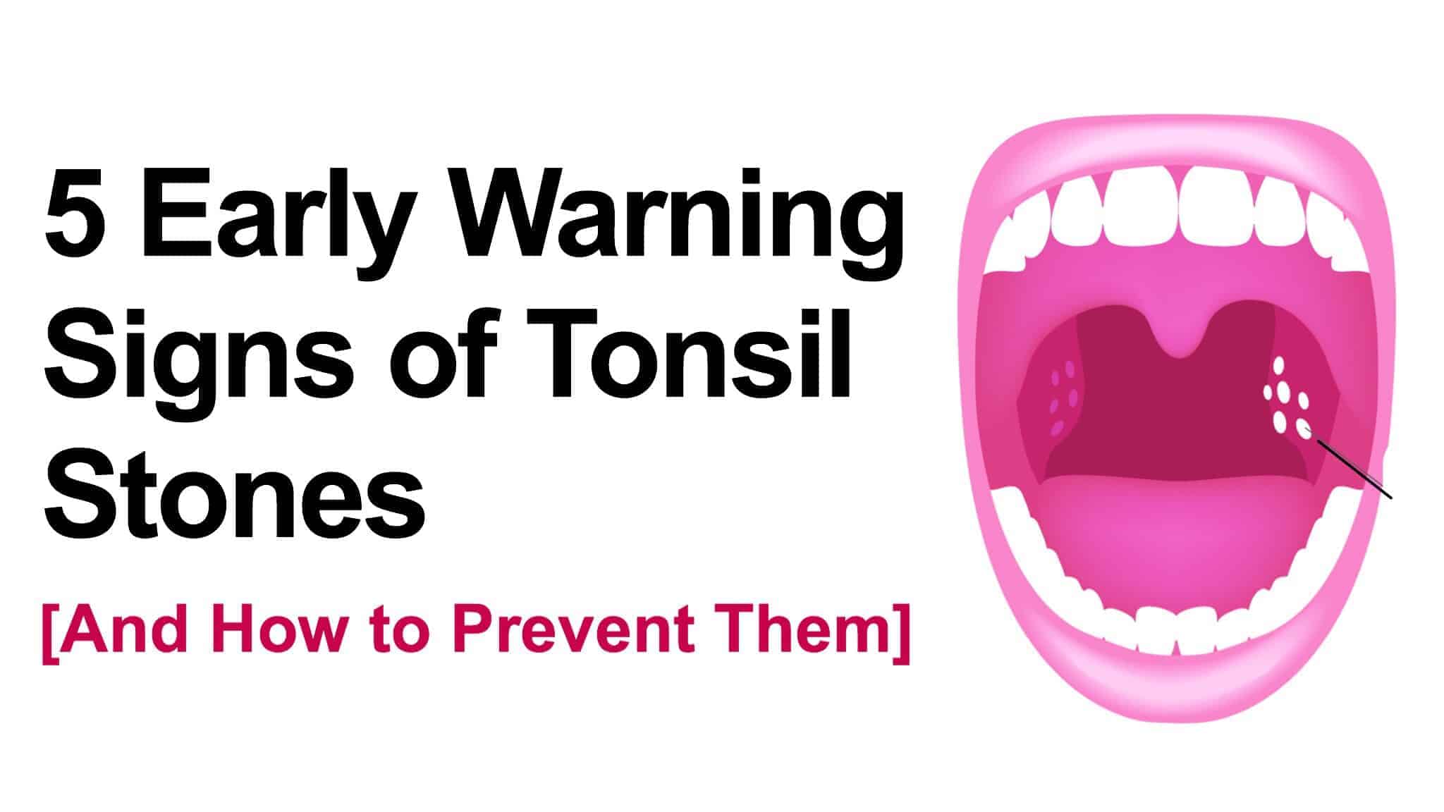 tonsil stones.