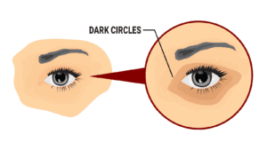 dark circles under eyes