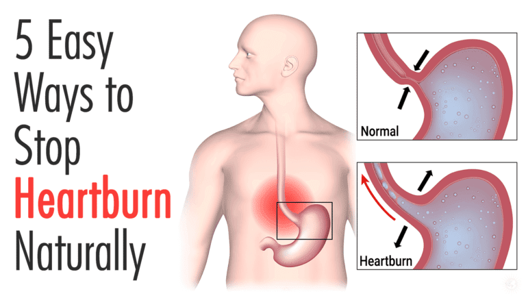 stop heartburn naturally