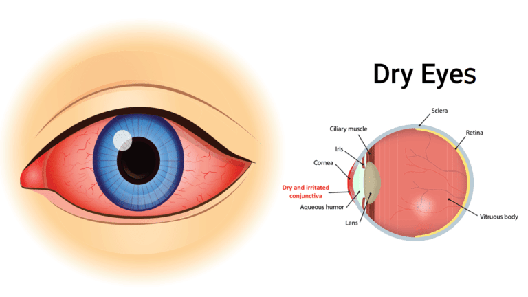 dry eyes