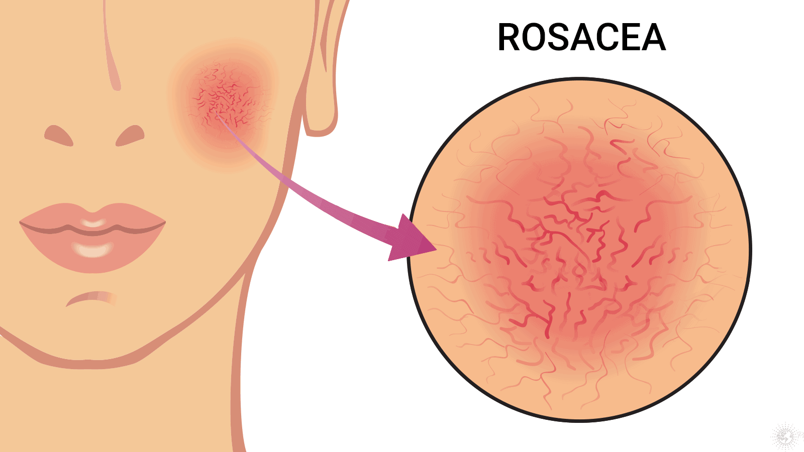 rosacea