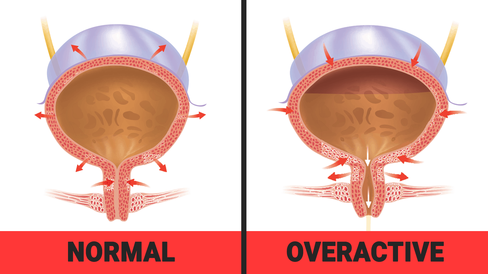 Image result for overactive bladder