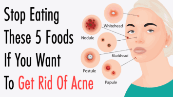 get rid of acne
