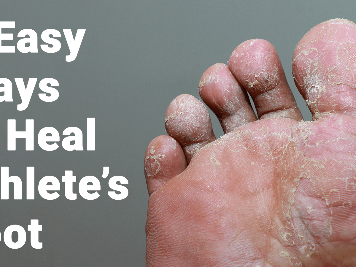 8 Easy Ways to Heal Athlete's Foot