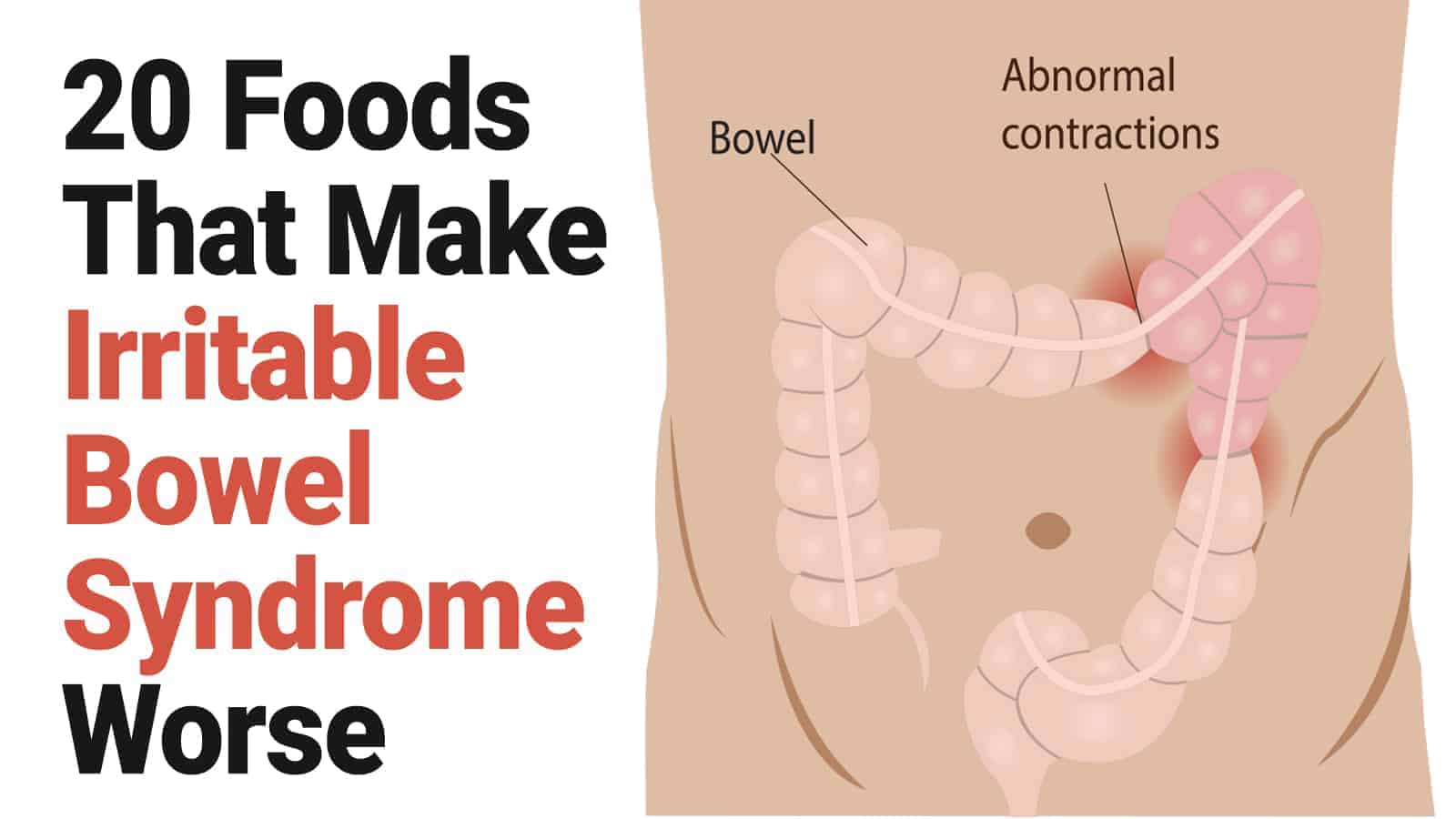 Irritable bowel syndrome - pelvic pain