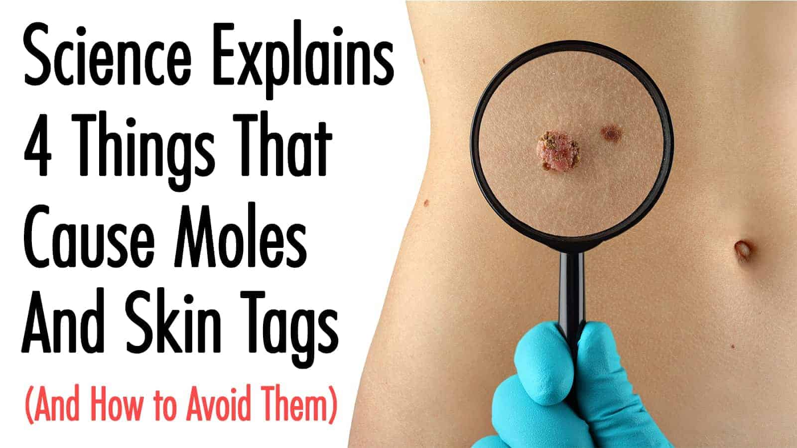 moles skin tags