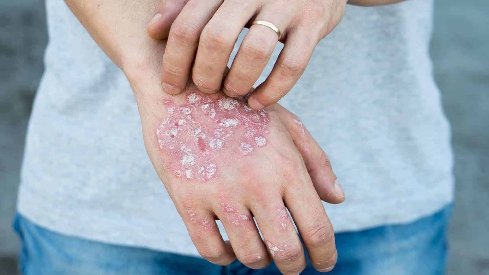 Image result for eczema"