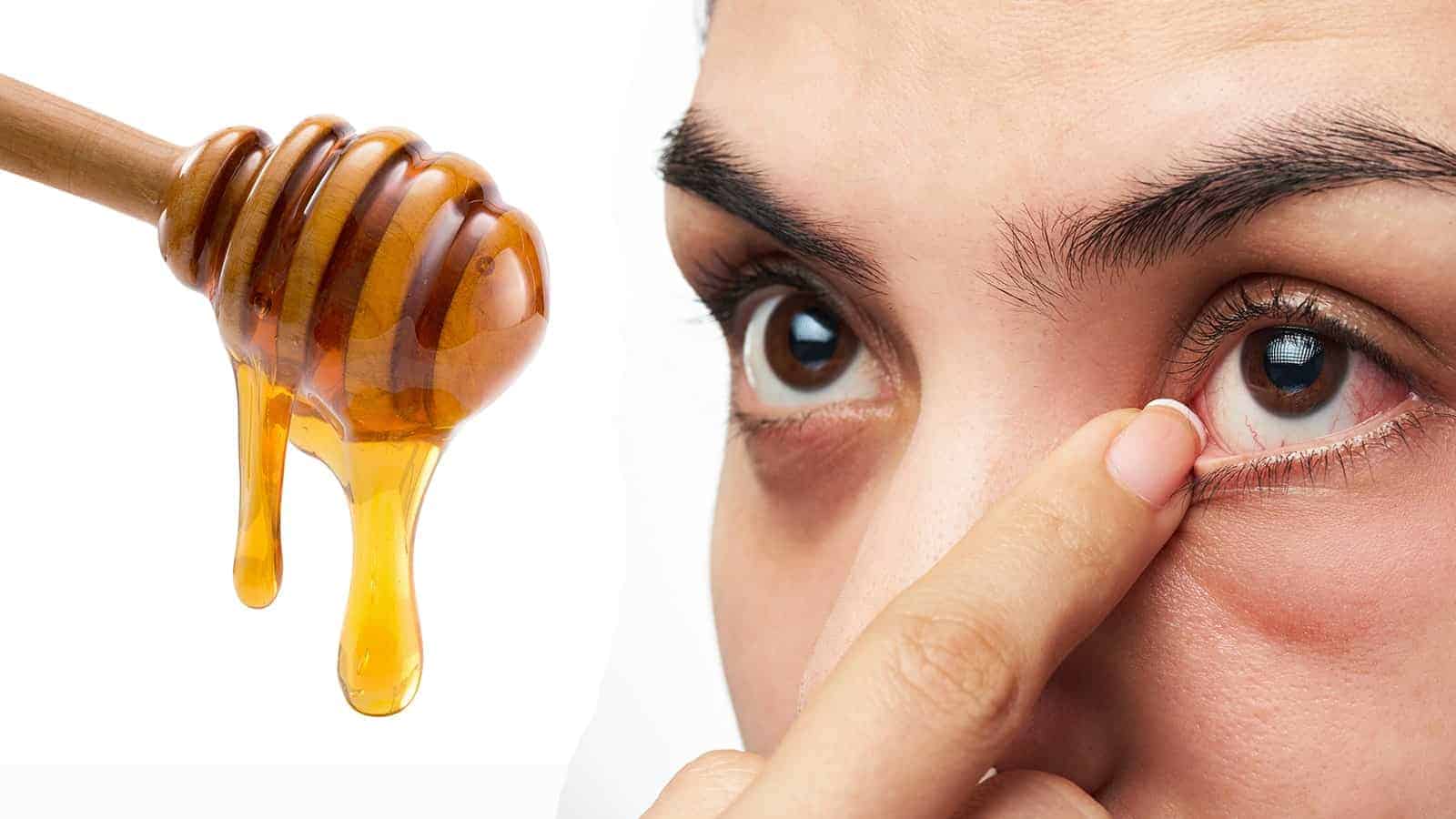 home remedies for eye pain
