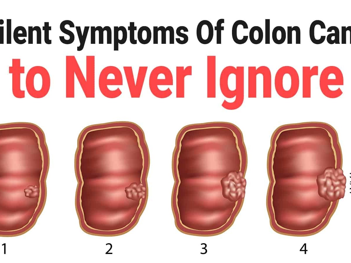 6 Silent Symptoms Of Colon Cancer To Never Ignore
