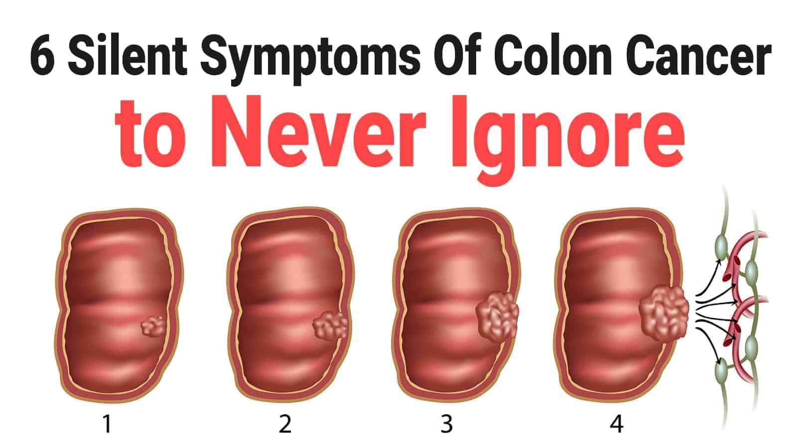 Cancer abdominal pain colon, Cancer causing abdominal pain