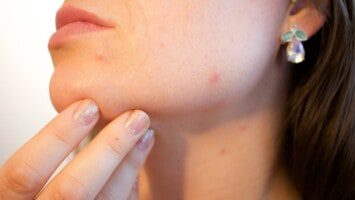 remove acne