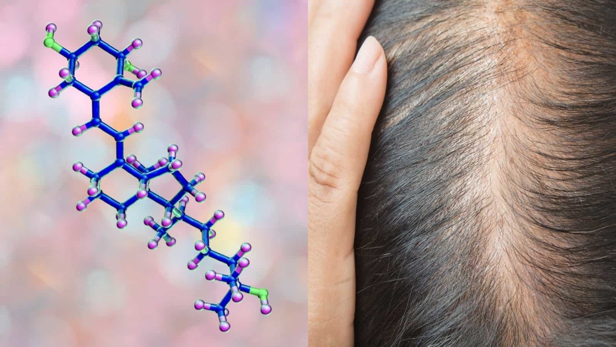 Researchers Reveal A Connection Between Vitamin D Deficiency And Hair Loss