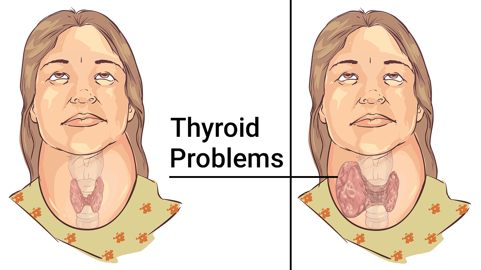 soybeans for thyroid