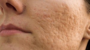 turmeric for skin - acne scars