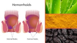 hemorrhoids