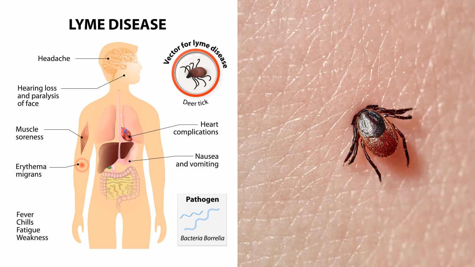 what is lyme disease in humans