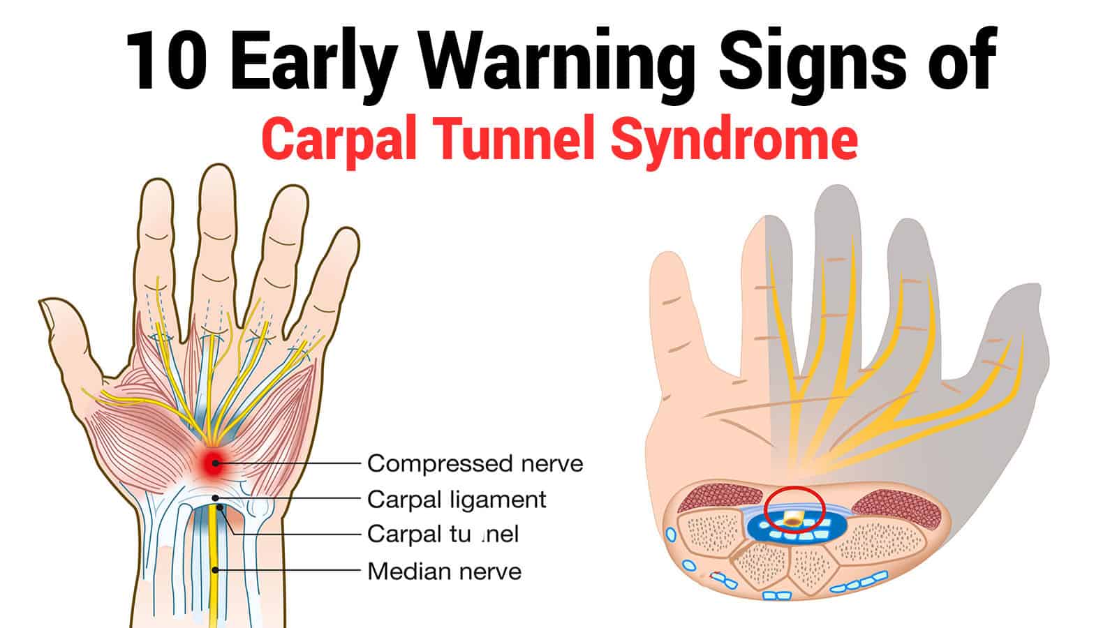 Gabapentin for Carpal Tunnel Syndrome