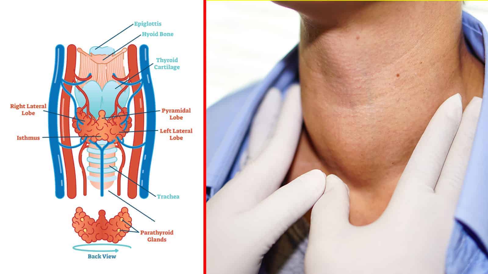 thyroid cancer