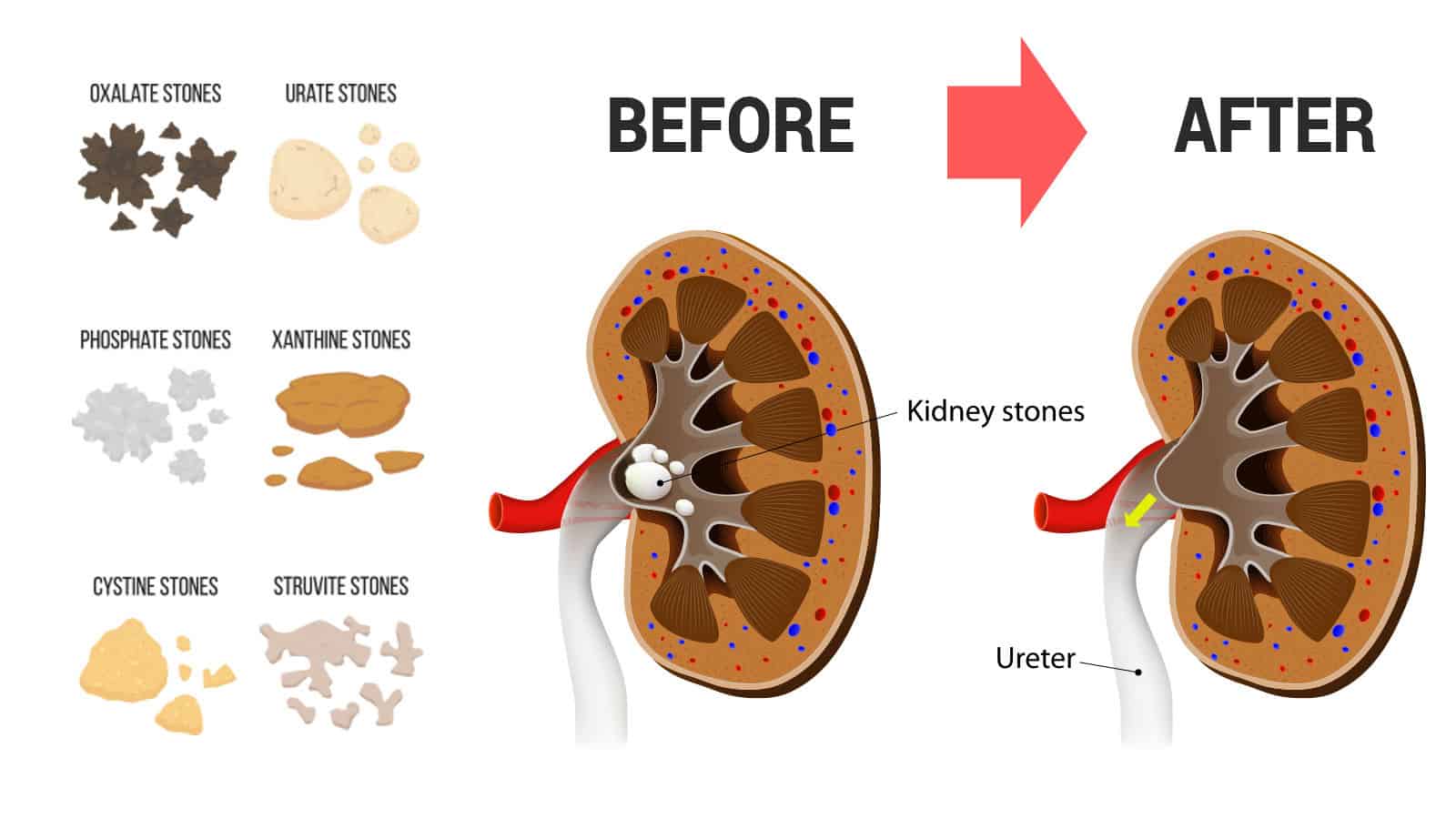 flush kidney stones