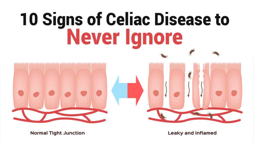 10 Signs of Celiac Disease to Never Ignore | 6 Minute Read