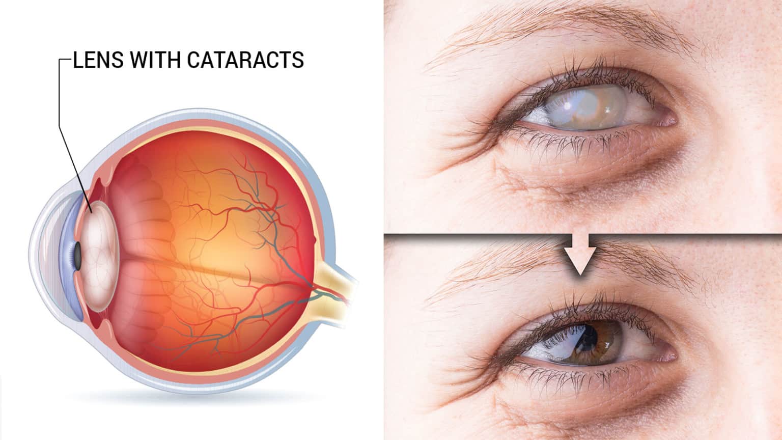 Ophthalmologists Reveal the Causes and Symptoms of Cataracts