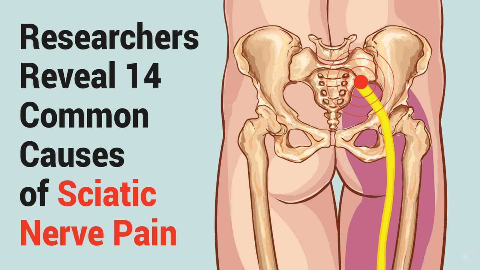 What Is the Most Effective Pain Relief for Sciatica? Symptom & Treatment