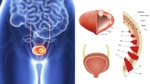 bladder cancer