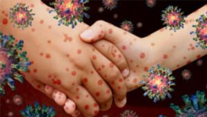 sepsis and chickenpox