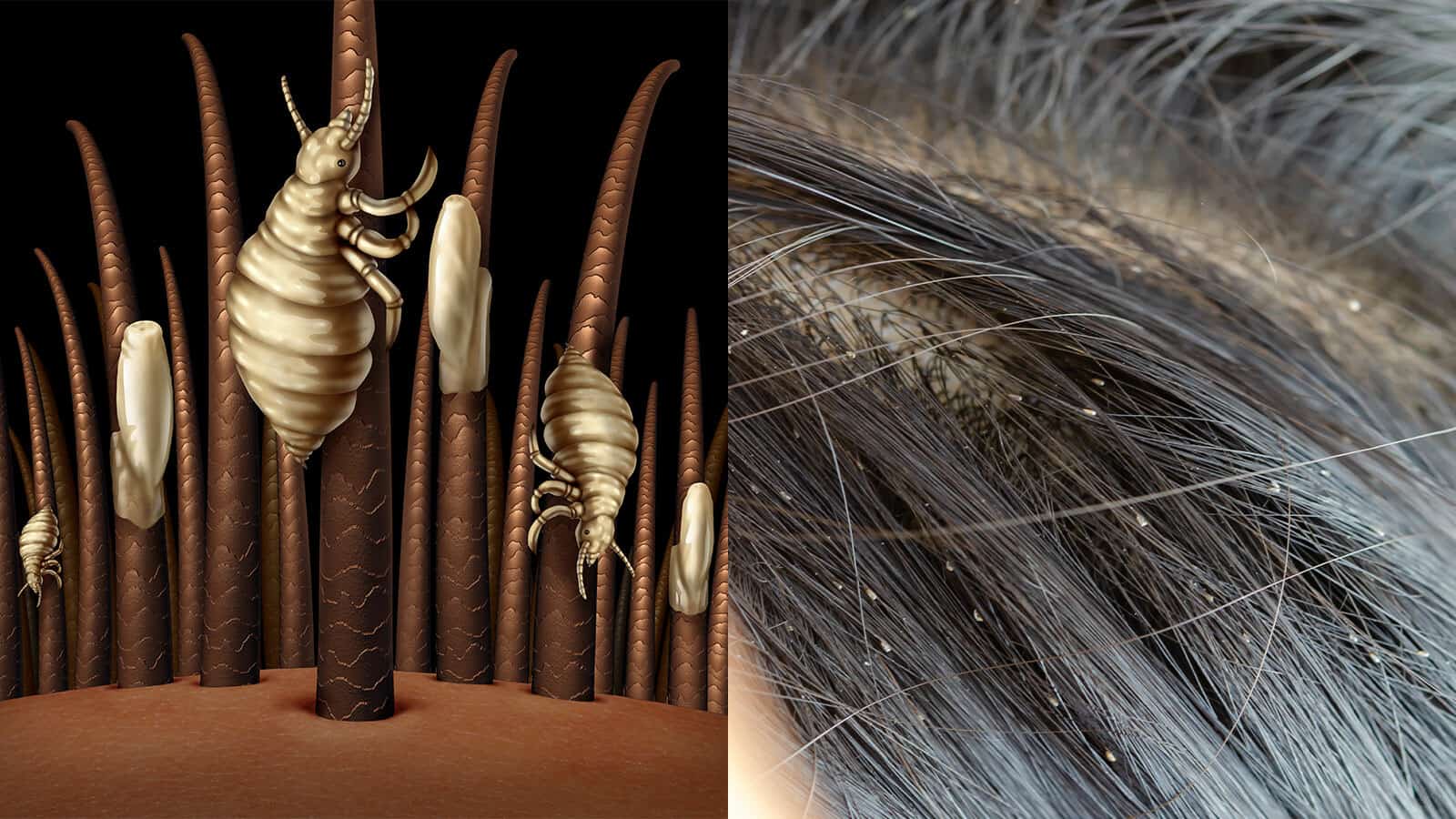 12 Natural Head Lice Remedies Never to Ignore | 7 Minute Read