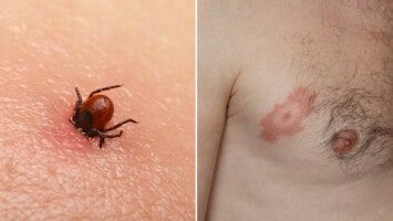 how to remove ticks from the skin