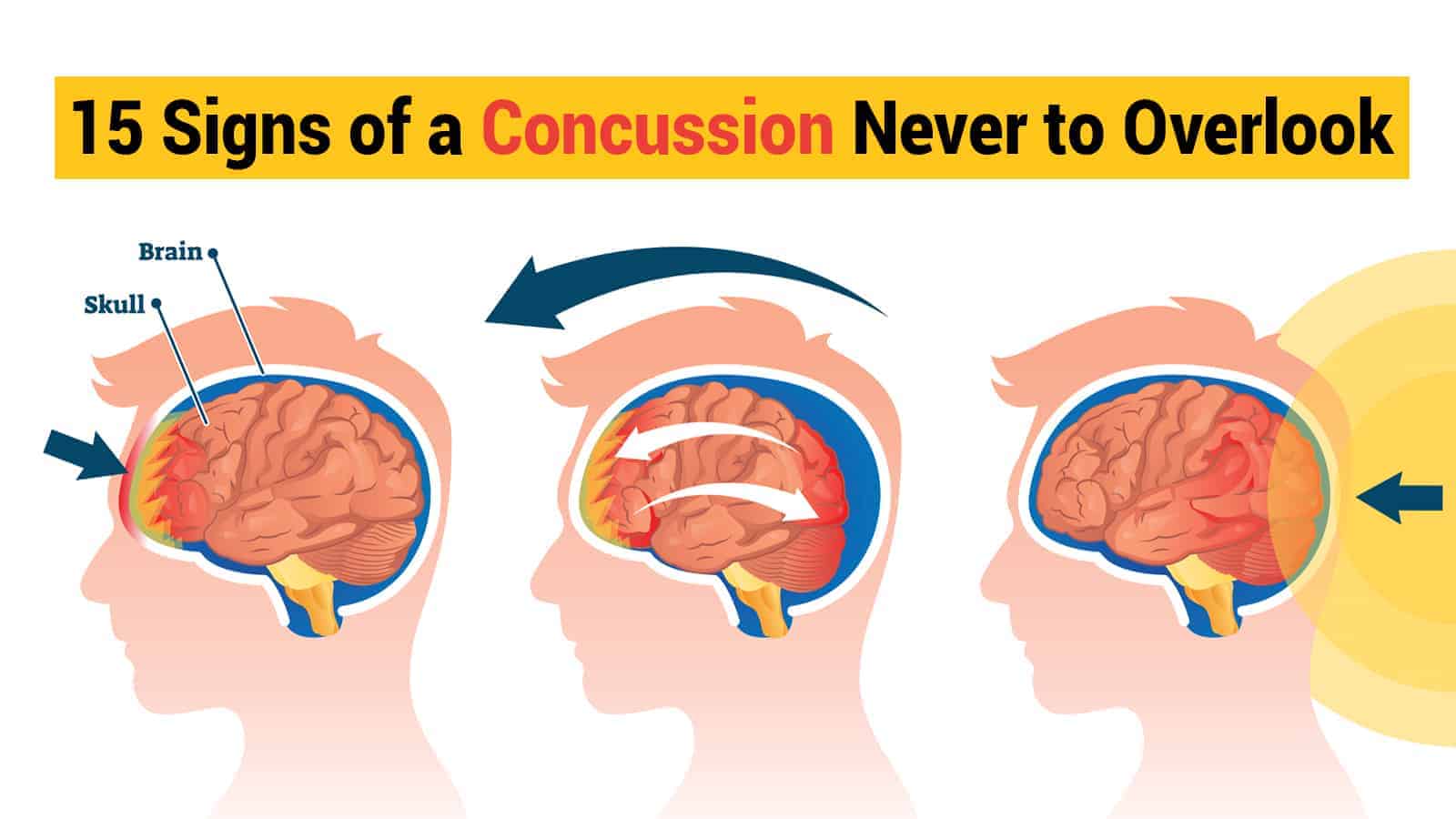 signs of concussion in children