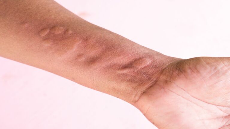 Doctors Explain What Happens To Your Body If You Develop Hives