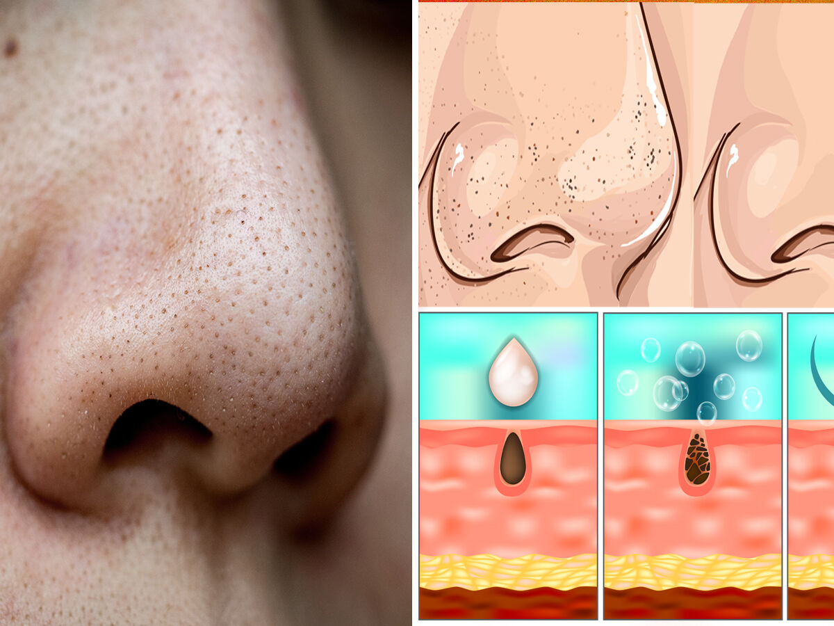 How to Keep Pores Unclogged? 