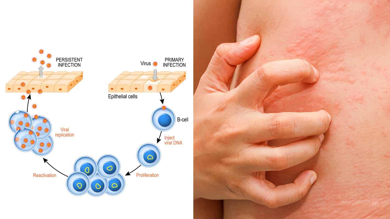 Epstein Barr Virus Symptoms In Children