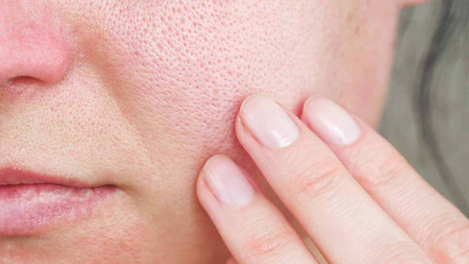 Dermatologists Reveal 10 Ways to Shrink Large Pores