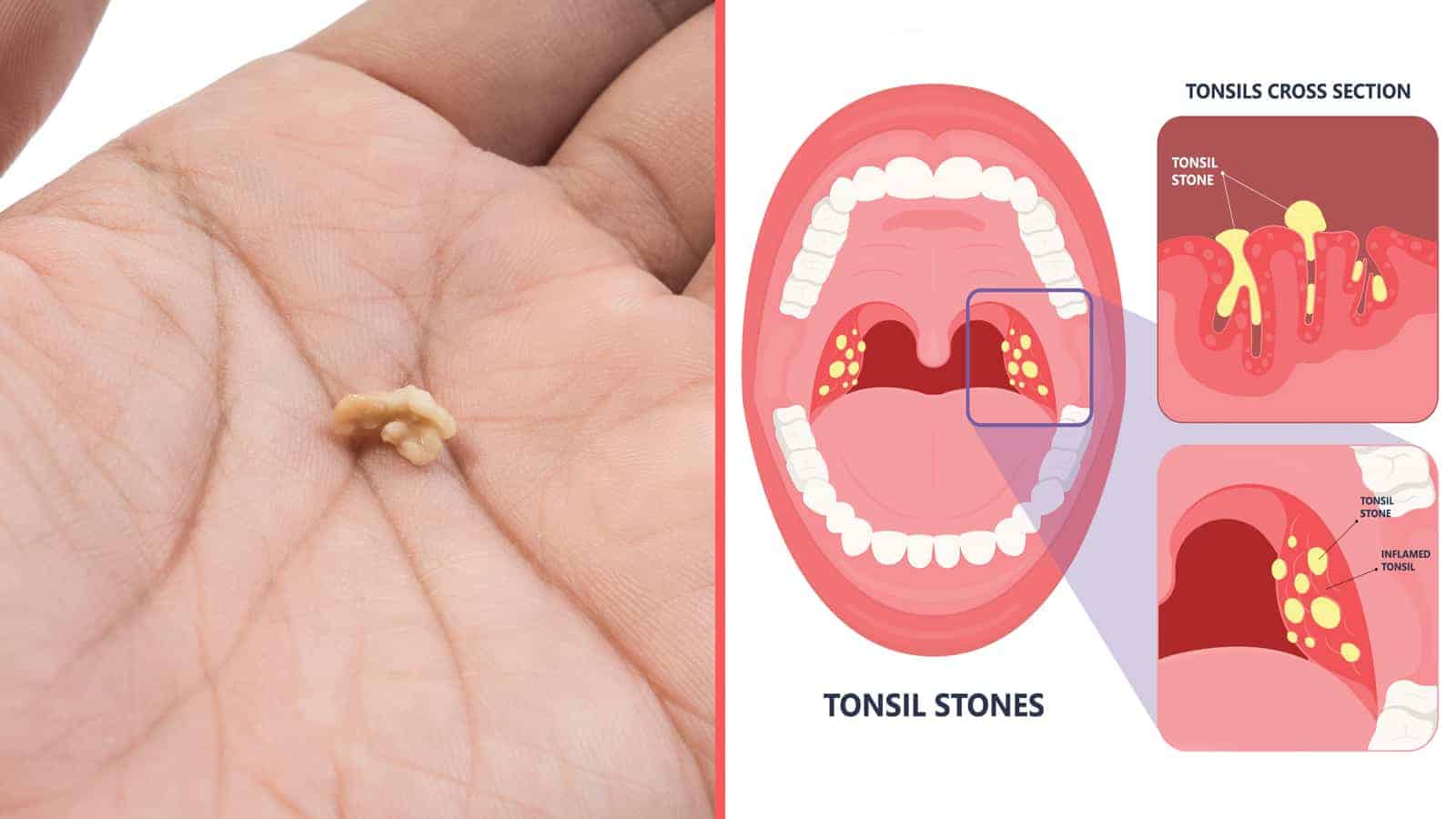 How to avoid tonsil stones