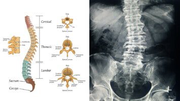 spinal alignment