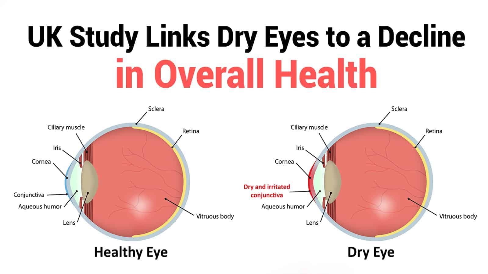 UK Study Links Dry Eyes for Overall Health Decline