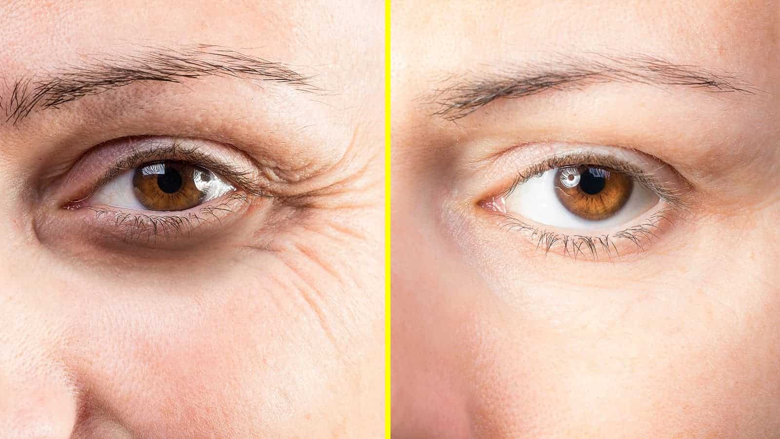 eye wrinkles