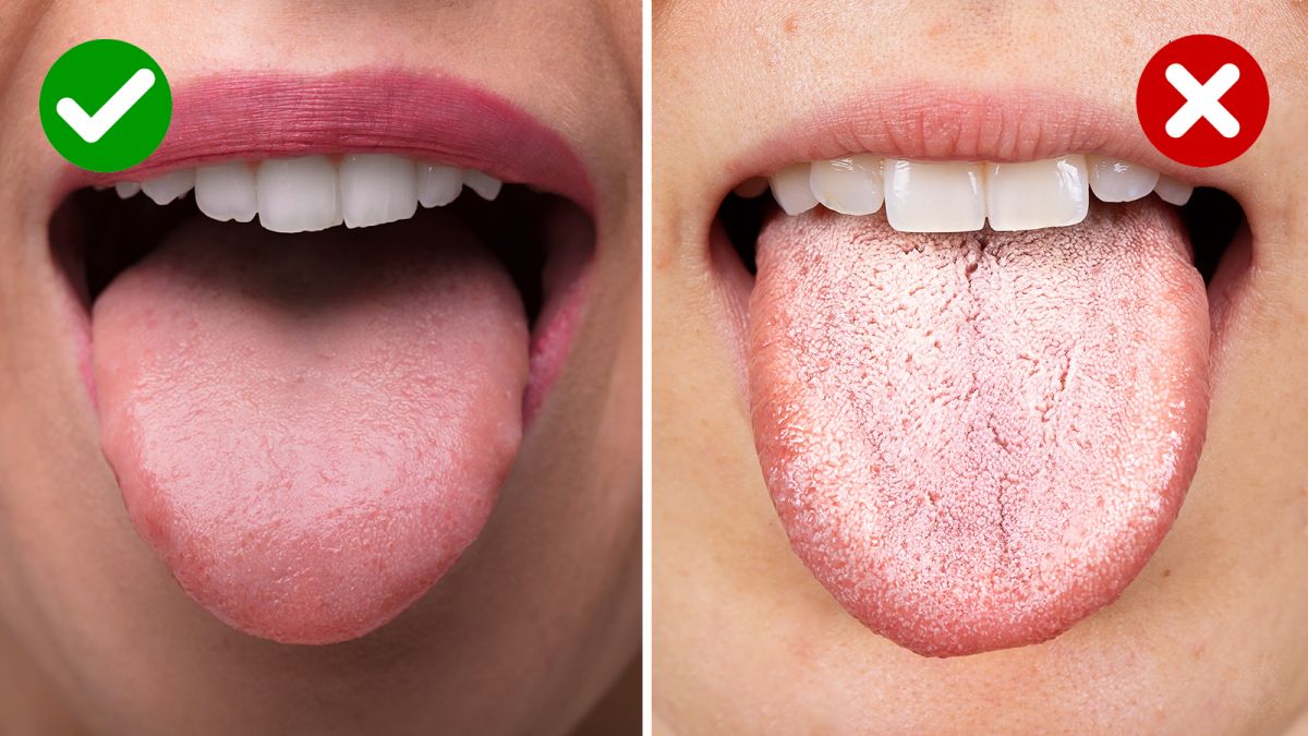 Normal Tongue Appearance