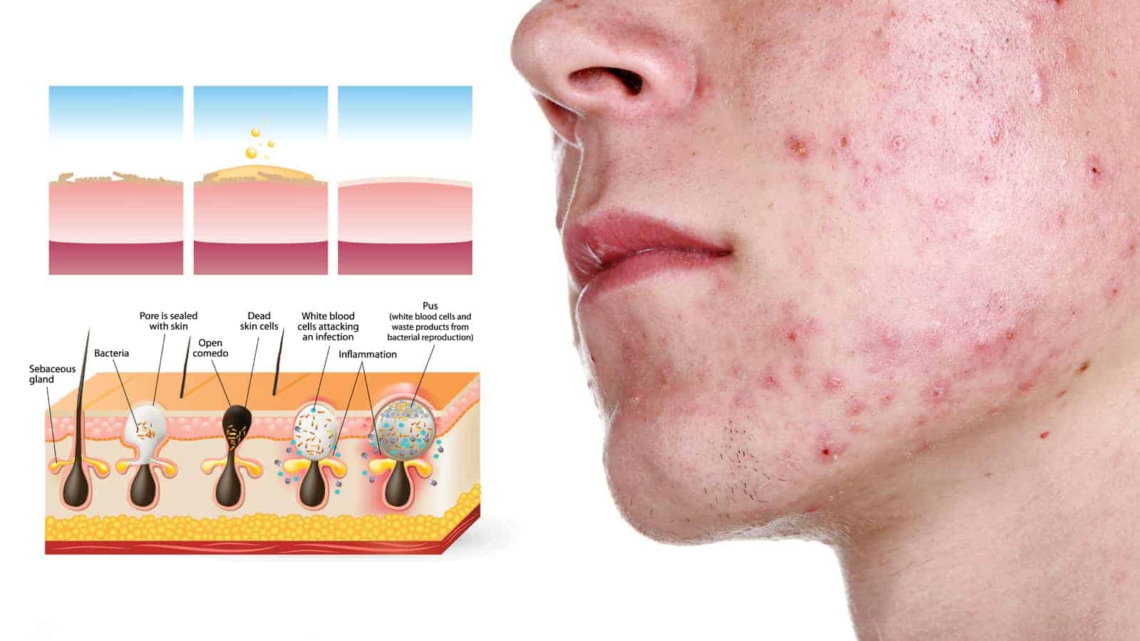 5 Problems In Your Body That Cause Pimples