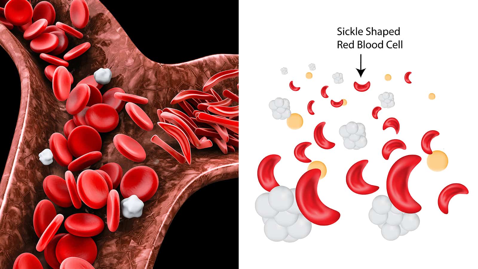 Boston College Reveals New Remedy for Sickle Cell Anemia