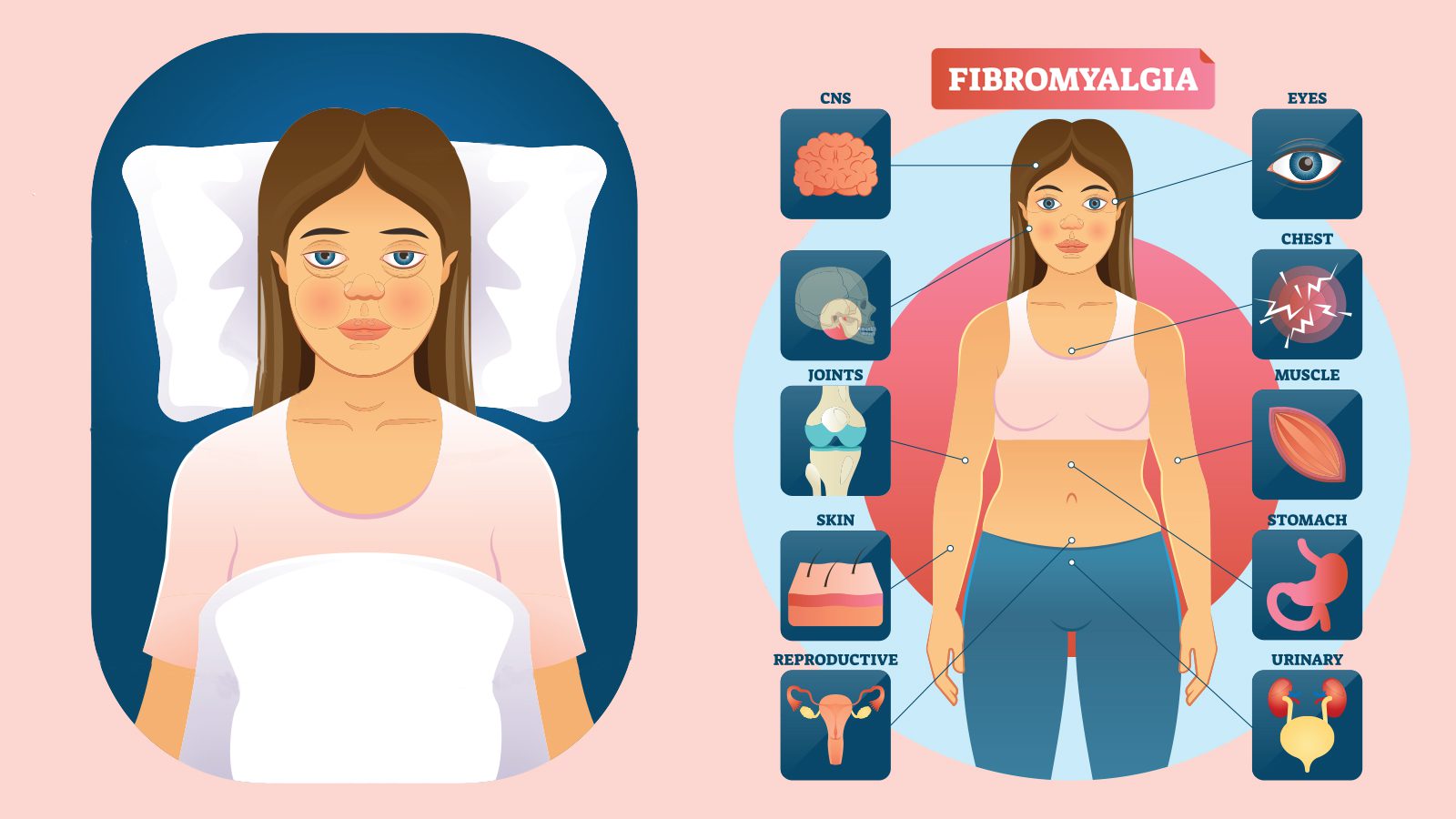signs of fibromyalgia