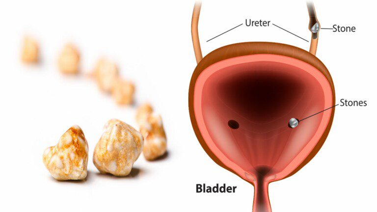 bladder stones