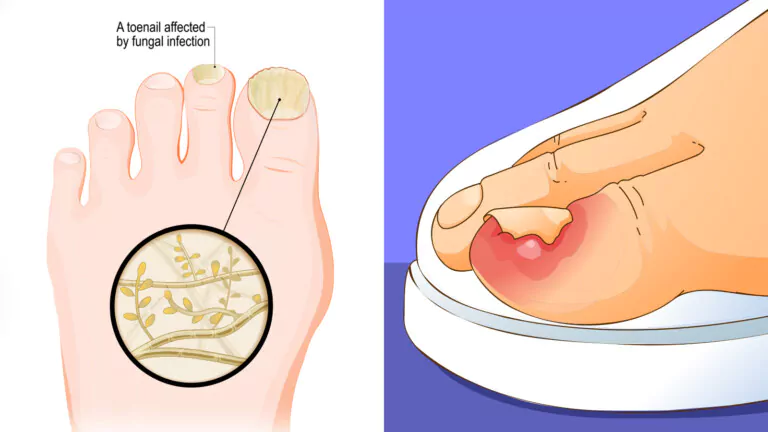 toenail infections fungal